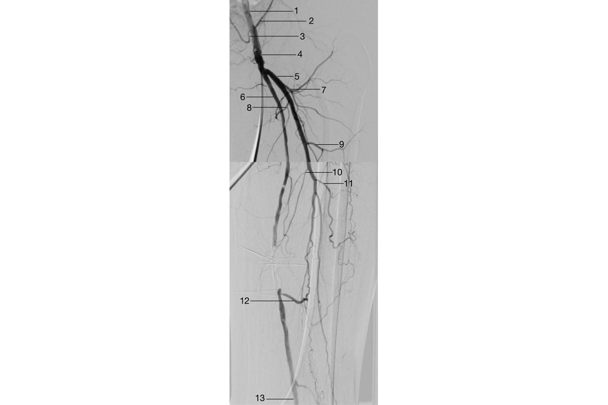 The iliac, femoral, and proximal hamstring segments of the distal arteries of the left leg. Image courtesy of Aleksei Kebriakov